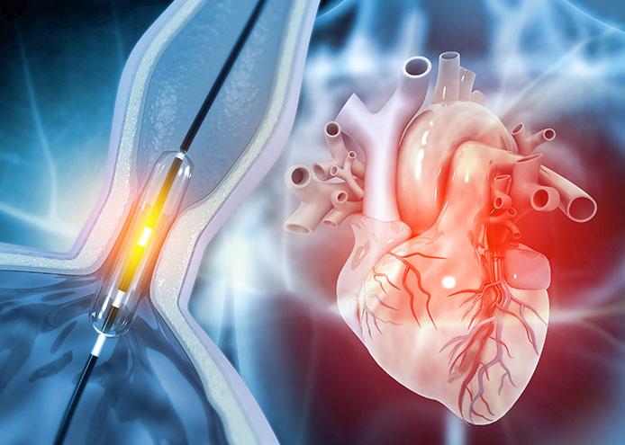 Angioplasty (PTCA - 1 Stent)